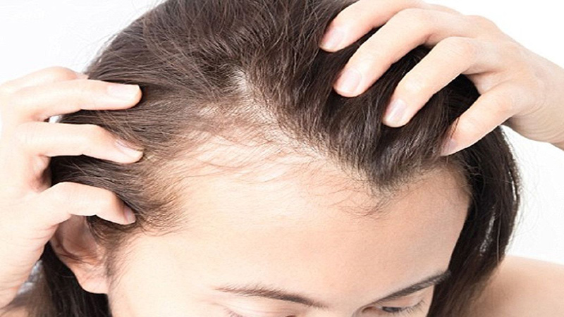 13 cách trị rụng tóc cho nam hiệu quả nhất hiện nay  websosanhvn