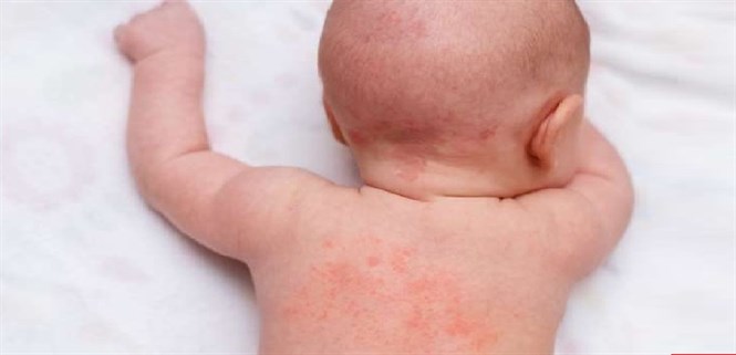 Dị ứng thời tiết ở trẻ có nguy hiểm không? Nguyên nhân, triệu chứng và cách điều trị bố mẹ cần biết
