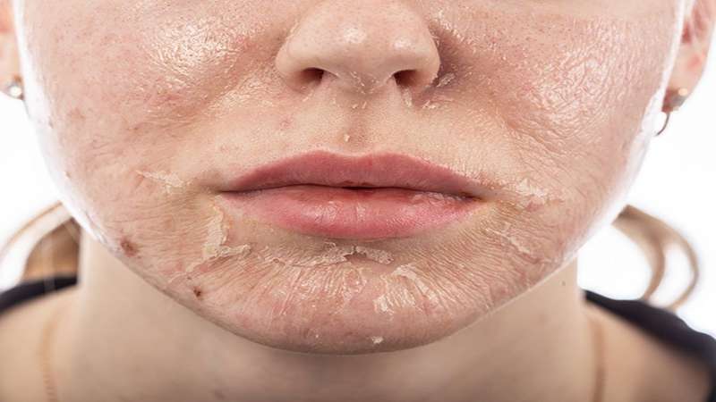 Phương pháp peel da với Glycolic Acid và những điều bạn cần biết
