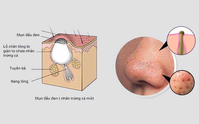 Nguyên nhân gây ra mụn đầu đen