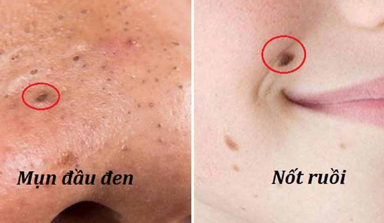 Thực hư việc mụn đầu đen nếu không nặn sẽ trở thành nốt ruồi
