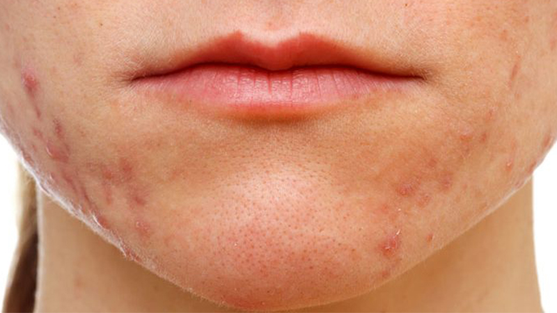 Tại sao Niacinamide có thể gây rát đỏ da