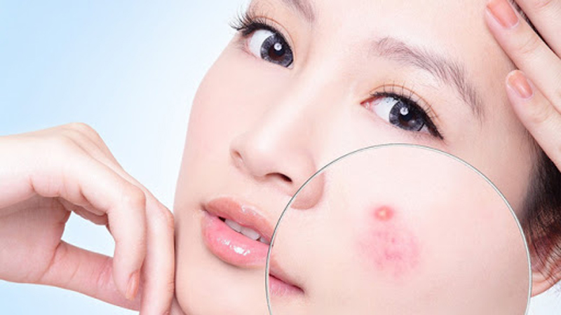 Trị mụn trứng cá