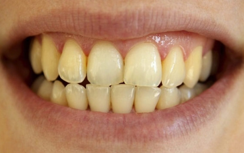 Vì sao bạn đánh răng hàng ngày mà răng vẫn bị ố vàng?