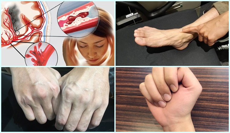 Tự kiểm tra nguy cơ tắc mạch máu ngay tại nhà 