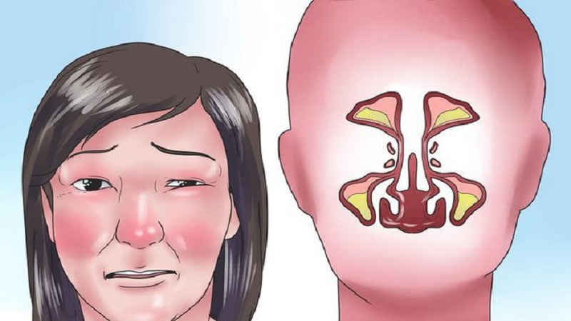 Ăn cay nhiều để chảy nước mũi tốt hay xấu?