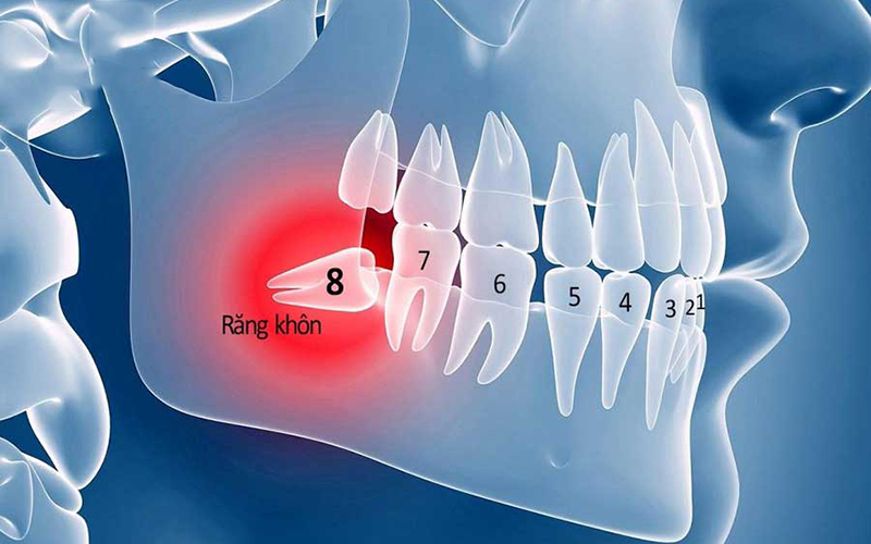 răng khôn răng khôn