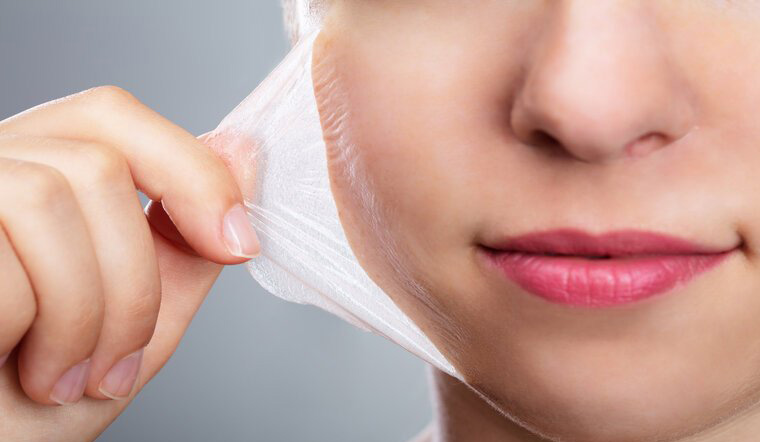 Tìm hiểu về Acid Peel - phương pháp trẻ hoá làn da