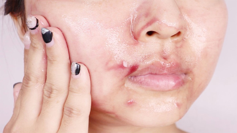 Tìm hiểu về Acid Peel – phương pháp trẻ hoá làn da