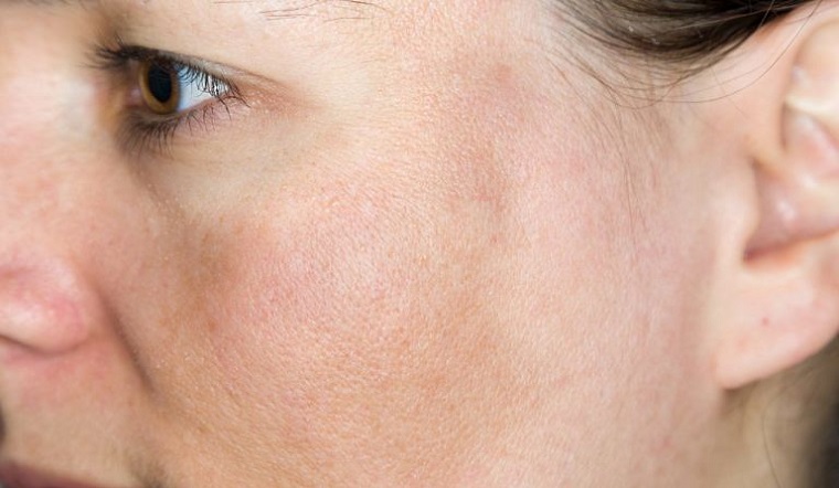 Tranexamic acid là gì? Tác dụng của Tranexamic acid với làn da