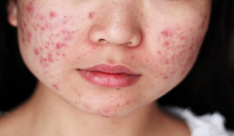 Bất ngờ với bí quyết điều trị mụn trứng cá bằng dầu gội trị gàu chứa kẽm "độc lạ"