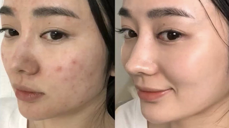 6 sai lầm khi sử dụng Retinoids cho người mới bắt đầu