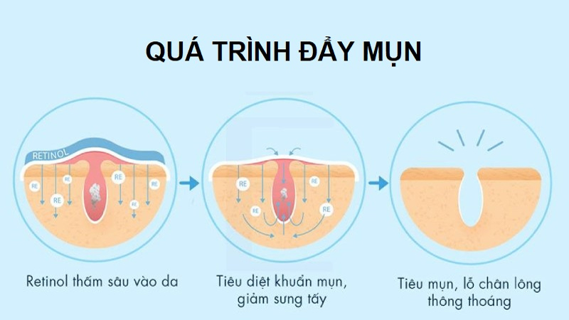 Quá trình Retinol đẩy mụn