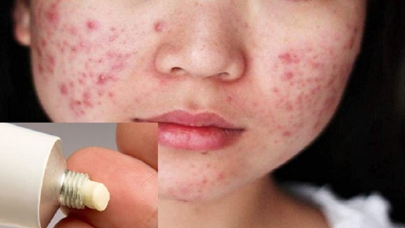 Bệnh nhân Rosacea (da ửng đỏ) có thể sử dụng Retinol không?