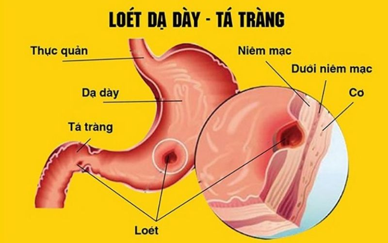 Cây sầu đâu trị viêm loét dạ dày, tá tràng