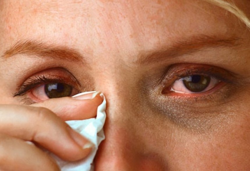 Đau mắt đỏ: Nguyên nhân, triệu chứng và cách phòng ngừa