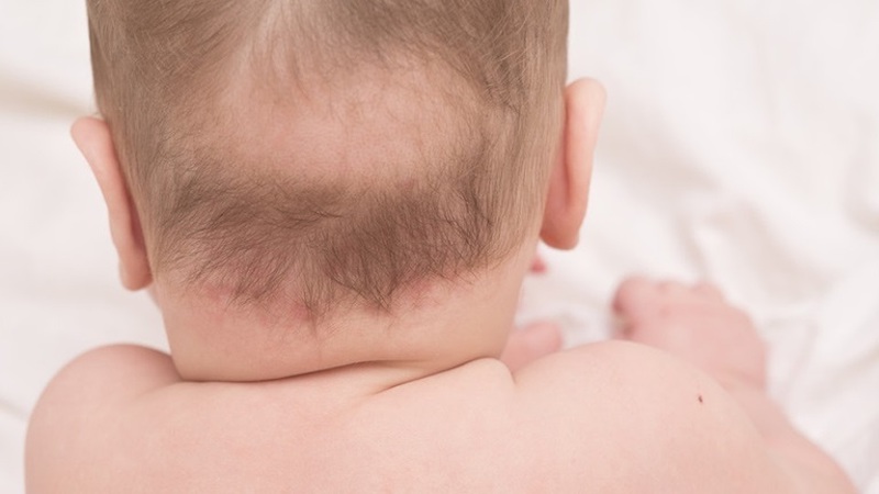 Nguyên nhân, dấu hiệu và cách điều trị rụng tóc vành khăn ở trẻ nhỏ