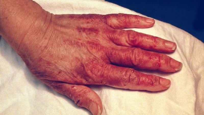 Tổn thương có thể phát triển theo kiểu phân bố giống hình găng tay trên bàn tay.