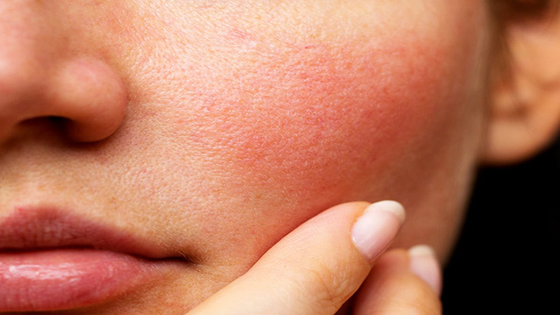Tình trạng da bị nhạy cảm Tình trạng da bị nhạy cảm