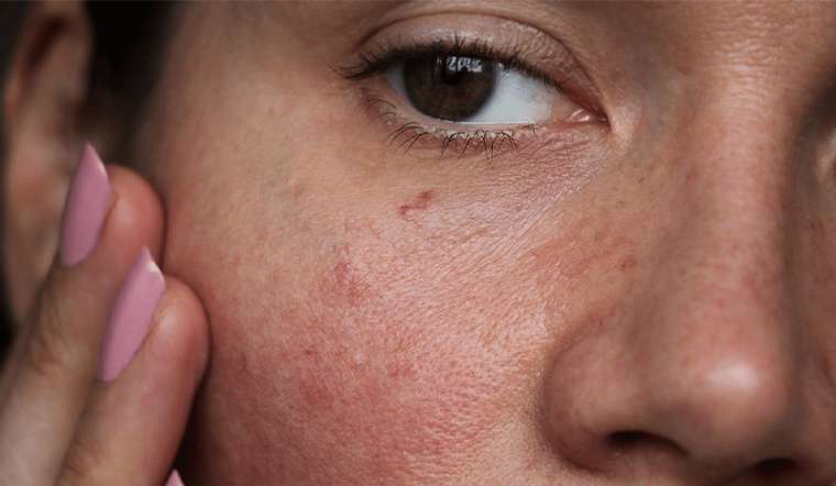 Bỏ túi 7 nguyên liệu tự nhiên giúp phục hồi làn da nhạy cảm