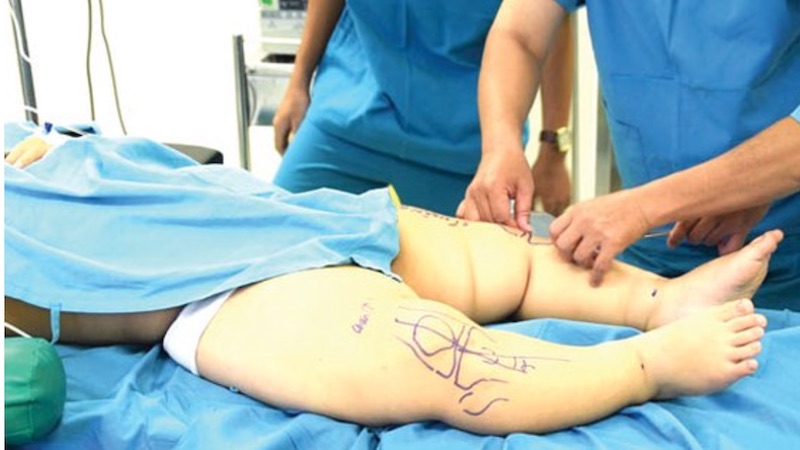 Phẫu thuật ngoại khoa chữa trị chân vòng kiềng