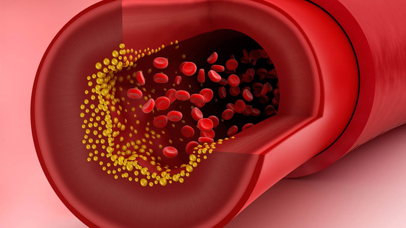 Actiso giúp làm giảm cholesterol có hại (LDL)