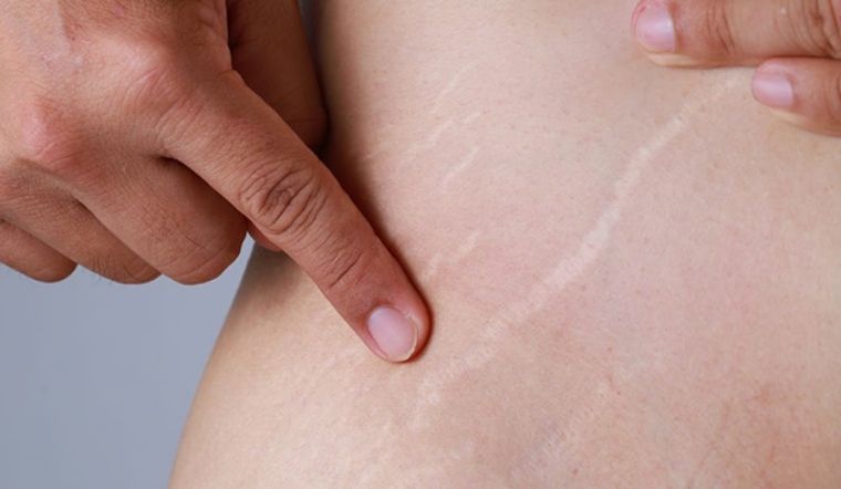 Bị rạn da mông phải làm sao? Cách điều trị tình trạng rạn da mông tại nhà