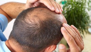 Trị hói bằng cách lăn kim và minoxidil 5% có thật sự hiệu quả?