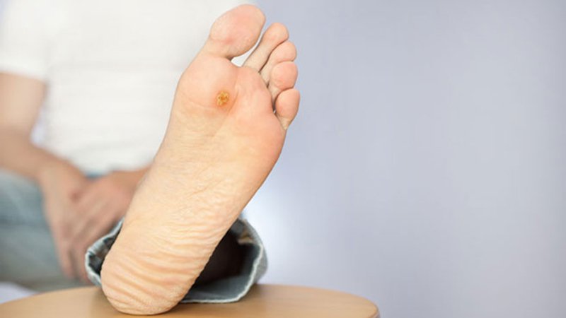 Mật ong giúp chữa lành vết loét bàn chân ở bệnh nhân mắc đái tháo đường 
