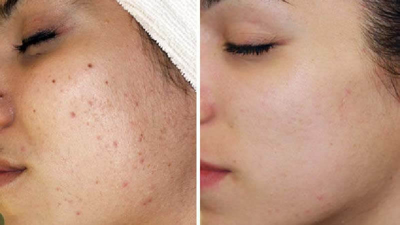 Cần phải chăm sóc tốt làn da bị mụn để tránh lây lan mụn trên da