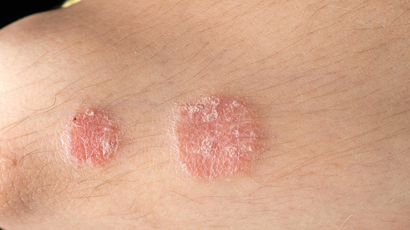 Làm giảm eczema và bệnh vảy nến