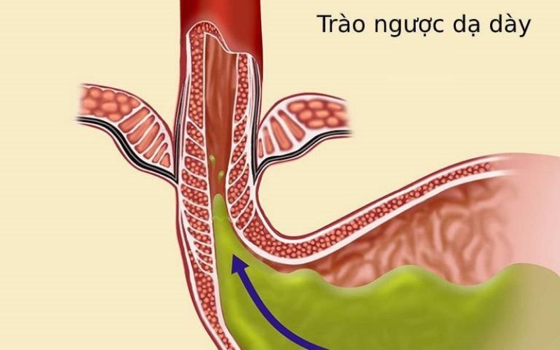 Trào ngược dạ dày thực quản là bệnh gì? Cần ăn uống thế nào khi mắc phải?