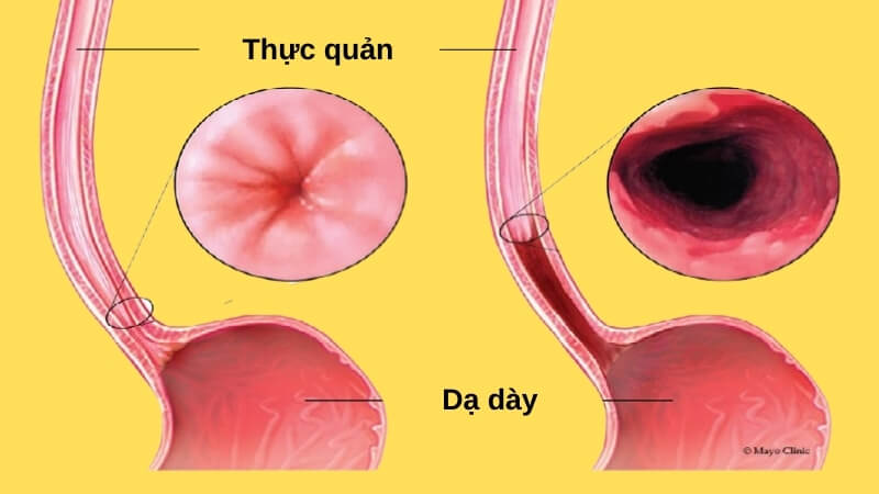 Viêm thực quản