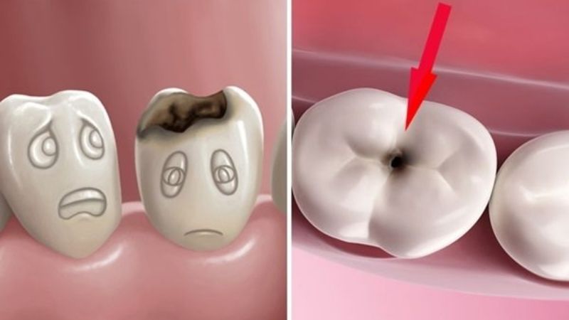 Các bệnh về răng miệng làm mòn men răng