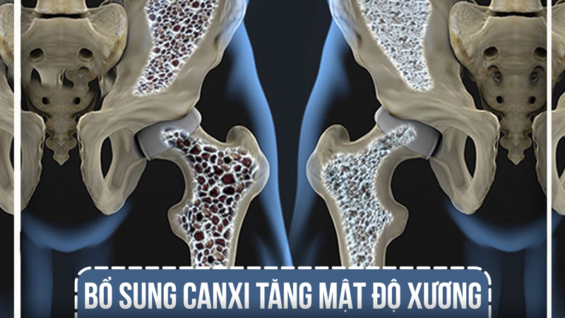 Bổ sung canxi giúp tăng mật độ xương