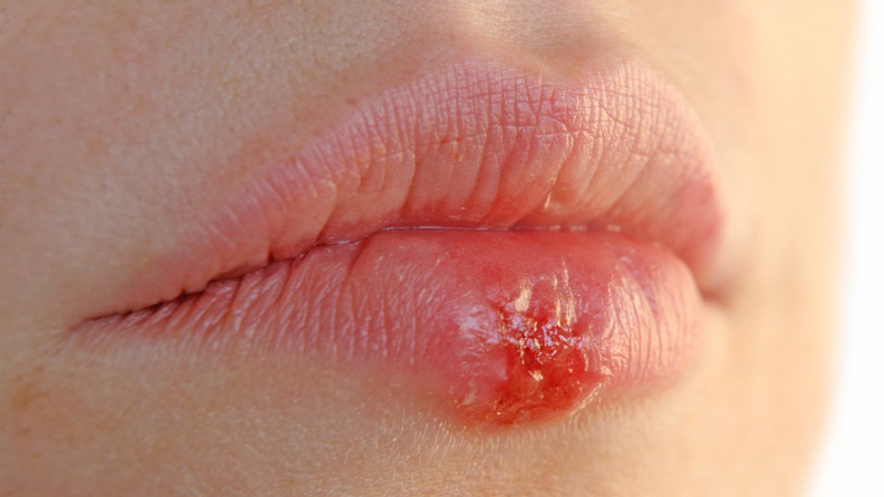 Lysine được sử dụng để điều trị vết loét được gây ra bởi virus Herpes Simplex Labialis