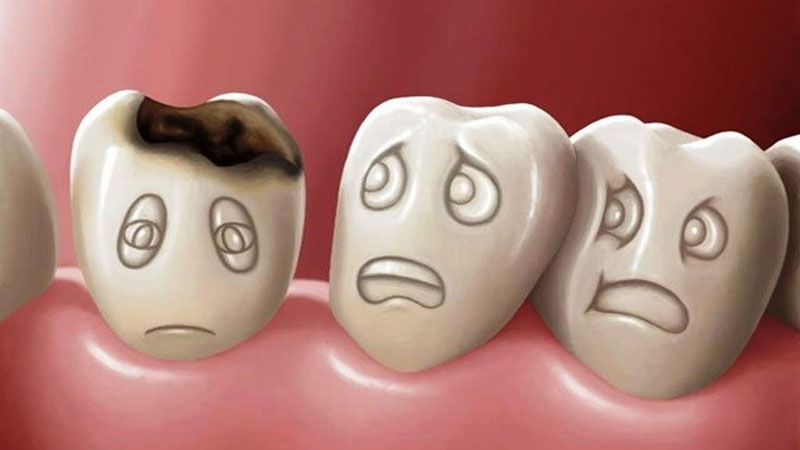Đường nuôi vi khuẩn trong răng dẫn đến sâu răng 