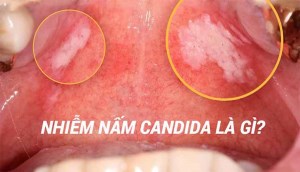 Bệnh nấm Candida là gì? Dấu hiệu nhận biết và cách điều trị