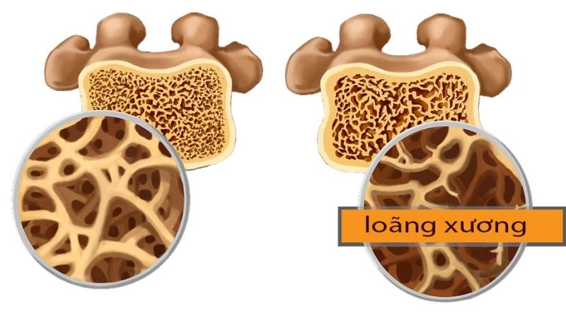 Người mắc bệnh loãng xương dễ bị thiếu mangan 