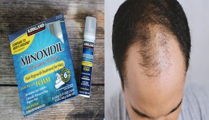 Thuốc trị hói Minoxidil 5% Kirkland có tốt không? Giá bao nhiêu? Mua ở đâu?