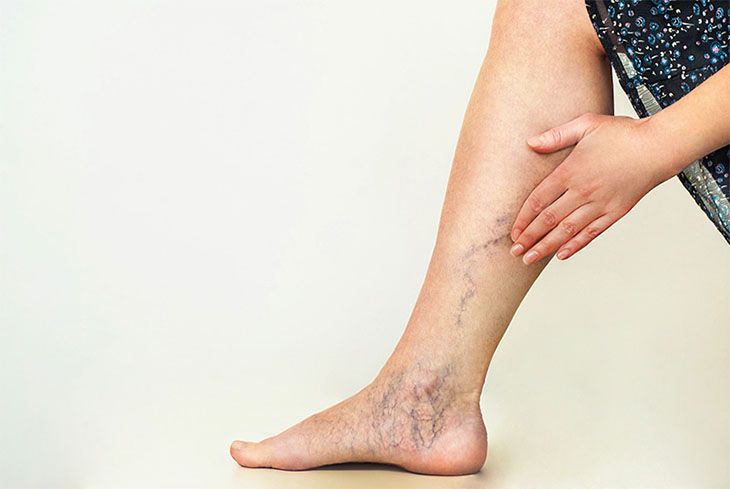 Lưu thông máu kém dẫn đến xuất hiện nhiều mạch máu ở bàn chân