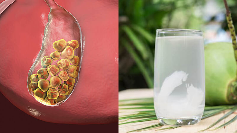 Cách chữa sỏi mật bằng nước dừa có thật sự hiệu quả?