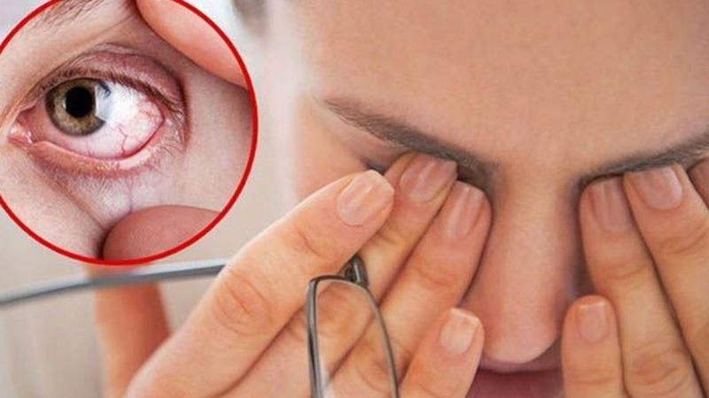 Rối loạn nối tiết cũng là một trong những nguyên nhân gây khô mắt