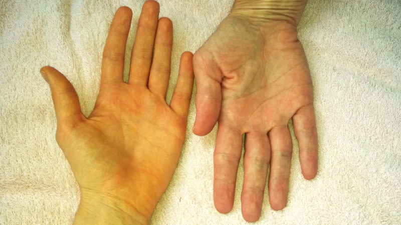 Ăn cà rốt quá nhiều và liên tục có thể bị vàng da