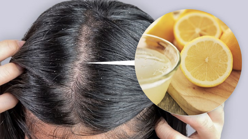 Các thành phần trong chanh giúp trị gàu và duy trì sức khỏe cho da đầu