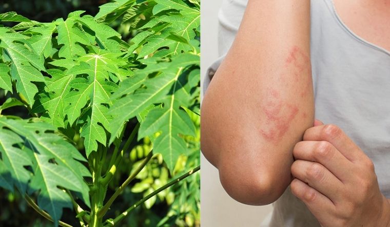 4 mẹo dân gian chữa viêm da cơ địa bằng lá đu đủ tác dụng nhanh
