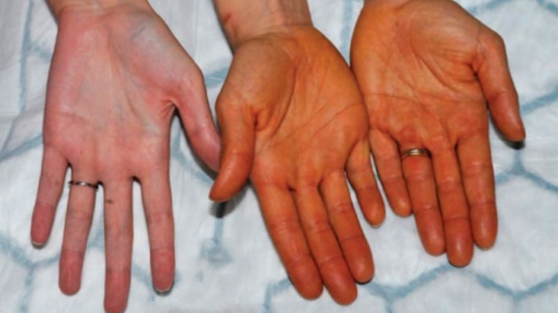 Hiện tượng lycopenodermia gây đổi màu da khi bổ sung quá nhiều lycopene