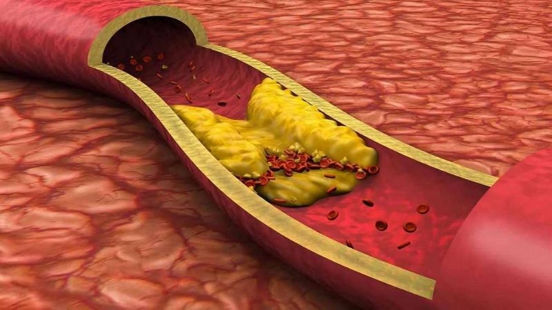 Chế độ ăn ít natri có thể làm tăng cả mức cholesterol LDL và chất béo trung tính.