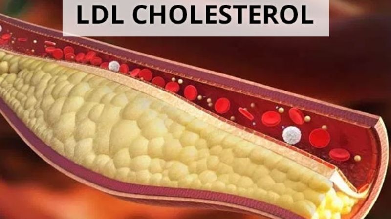 Khi dư thừa LDL, các mảng cholesterol này tích tụ trong động mạch