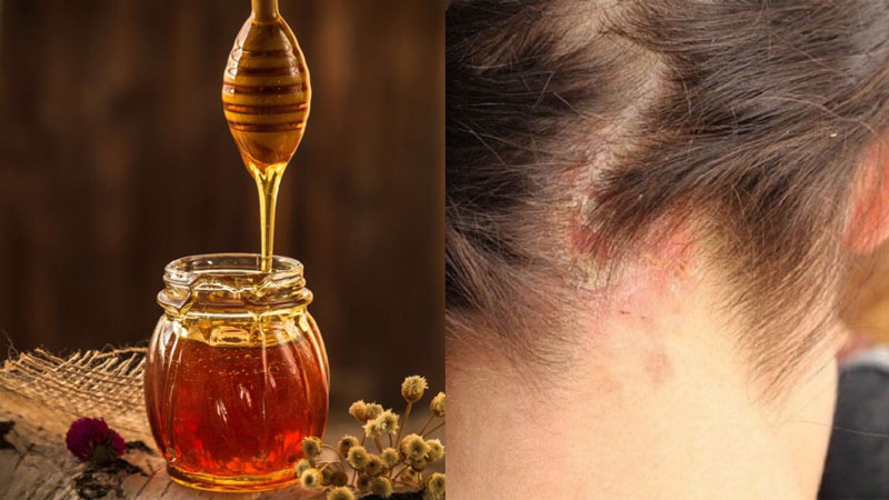  Mật ong có đặc tính chống oxy hóa và chống viêm giúp giảm các tình trạng viêm da đầu 